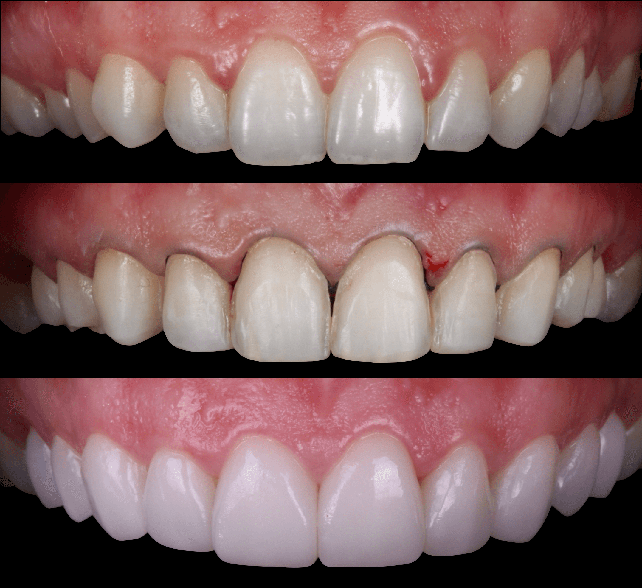 Minimal-prep veneers sequence — before, after preparation, and final result at Transcend Dentistry Vancouver