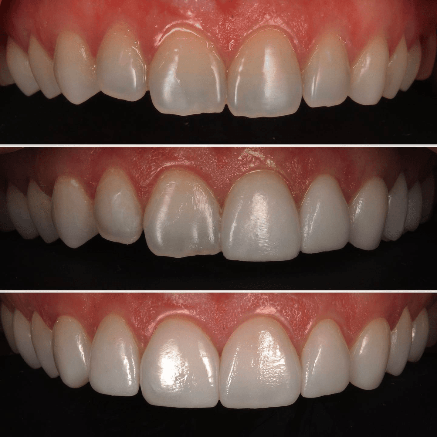 No-prep veneers sequence — before, try-in, and final result at Transcend Dentistry Vancouver